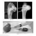 Fig. 02 - Device and method for treating osteonecrosis