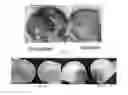 Fig. 03 - Device and method for treating osteonecrosis