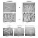 Fig. 05 - Device and method for treating osteonecrosis