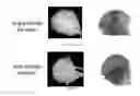 Fig. 06 - Device and method for treating osteonecrosis