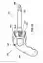 Fig. 40 - System and method for improved gas recirculation in surgical trocars with pneumatic sealing