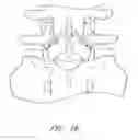 Fig. 03 - Method and apparatus for spinal stabilization