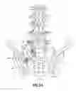 Fig. 26 - Apparatus and method for percutaneously extending an existing spinal construct