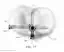 Fig. 11 - Adjustable devices for treating arthritis of the knee