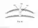 Fig. 16 - Bone plate system and method