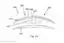 Fig. 17 - Bone plate system and method