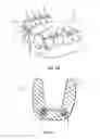 Fig. 02 - DENTAL PROSTHESIS AND METHOD FOR REMOVAL