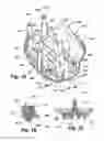 Fig. 18 - Removable fluid connection fitting for oral irrigator