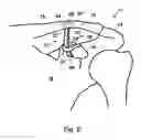 Fig. 07 - Joint stabilisation