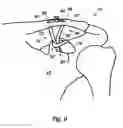 Fig. 08 - Joint stabilisation