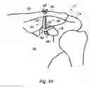 Fig. 09 - Joint stabilisation