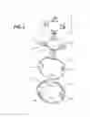 Fig. 02 - Accommodative intraocular lens