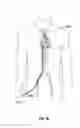 Fig. 36 - Prosthesis, delivery device and methods of use