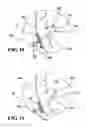 Fig. 09 - Papillary Muscle Position Control Devices, Systems, And Methods