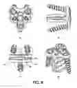 Fig. 10 - Cervical spine fixation apparatus