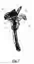 Fig. 08 - Scapular anchor for fixing a glenoid component of a shoulder joint prosthesis to a scapula with compromised anatomy and related method for manufacturing said scapular anchor