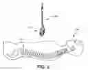 Fig. 03 - Spinal fusion implant