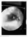 Fig. 08 - Implant stent device