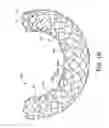 Fig. 03 - Balloon expandable endoprosthesis