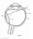 Fig. 03 - Vitreoretinal instruments for fluid aspiration