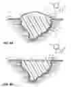 Fig. 05 - Vacuum wound therapy wound dressing with variable performance zones