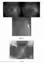 Fig. 09 - METHODS OF DIAGNOSING AND TREATING VASCULAR ASSOCIATED MACULOPATHY AND SYMPTOMS THEREOF