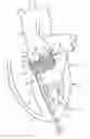 Fig. 01 - Catheter-based heart support system and method of implanting thereof