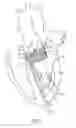Fig. 02 - Catheter-based heart support system and method of implanting thereof