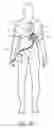 Fig. 16 - Catheter-based heart support system and method of implanting thereof