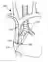 Fig. 01 - Method and system of utilizing ECG signal for central venous catheter tip positioning