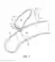 Fig. 02 - Deployment constraining sheath that enables staged deployment by device section