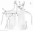 Fig. 01 - Transvenous method of treating sleep apnea