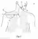 Fig. 02 - Transvenous method of treating sleep apnea