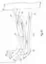 Fig. 06 - Transvenous method of treating sleep apnea