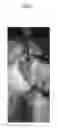 Fig. 08 - Nerve stimulation device for treating or reducing paralysis