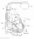 Fig. 01 - Implantable cardiac resynchronizer with biventricular pacing and detection of loss of capture and anodal stimulation