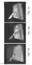 Fig. 04 - SYSTEMS AND METHODS OF OPTICAL COHERENCE TOMOGRAPHY STEREOSCOPIC IMAGING FOR IMPROVED MICROSURGERY VISUALIZATION