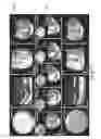 Fig. 09 - SYSTEMS AND METHODS OF OPTICAL COHERENCE TOMOGRAPHY STEREOSCOPIC IMAGING FOR IMPROVED MICROSURGERY VISUALIZATION