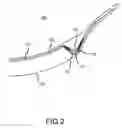 Fig. 03 - Contact lens having a space