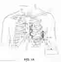 Fig. 02 - Supraventricular tachyarrhythmia discrimination