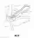 Fig. 33 - Hip surgery systems and methods