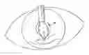 Fig. 01 - Expansion ring for eyeball tissue