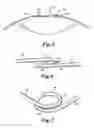 Fig. 04 - Expansion ring for eyeball tissue