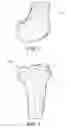 Fig. 02 - METHODS AND APPARATUS FOR PERFORMING KNEE ARTHROPLASTY