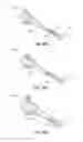 Fig. 35 - Catheter-based system for delivery and retrieval of a leadless pacemaker