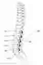 Fig. 01 - DISC AND MOTION PRESERVING IMPLANT SYSTEM