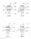 Fig. 09 - DISC AND MOTION PRESERVING IMPLANT SYSTEM