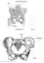 Fig. 02 - METHODS, IMPLANTS, AND TOOLS FOR FUSION OF SACROILIAC JOINTS