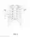 Fig. 03 - Sternum fixation device and method
