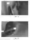 Fig. 04 - Endoscopic view of invasive procedures in narrow passages